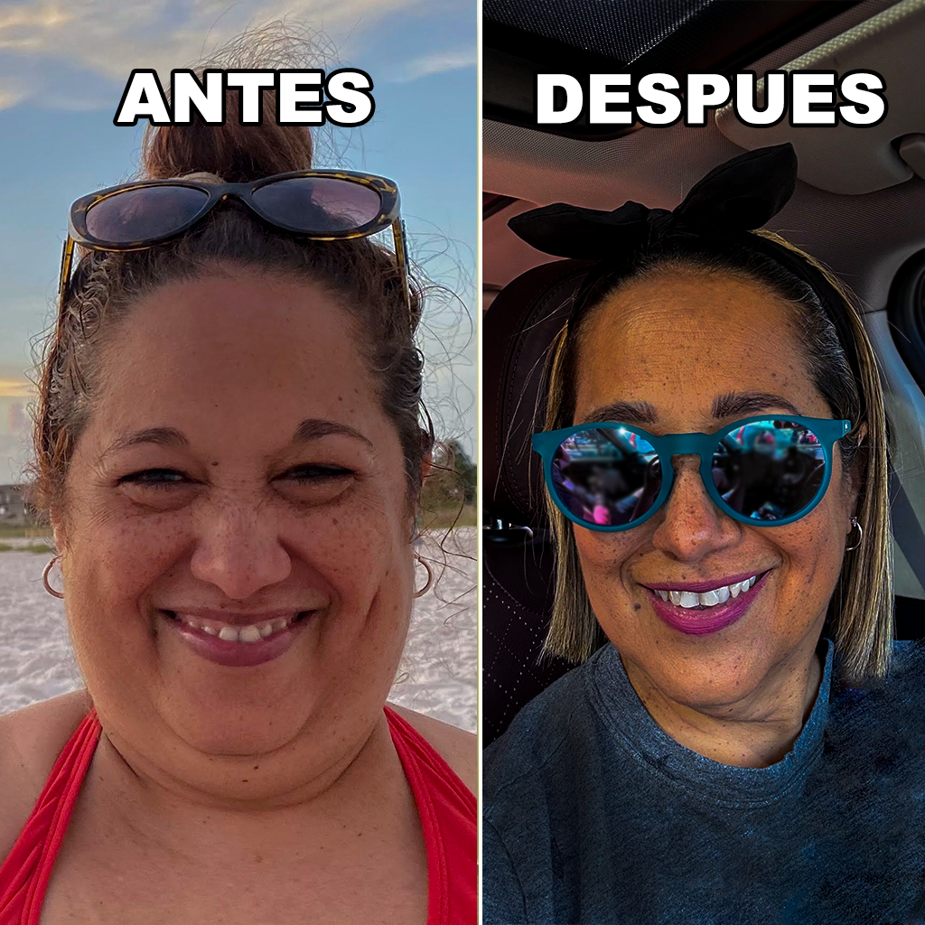 Zaira A. - Antes y Después